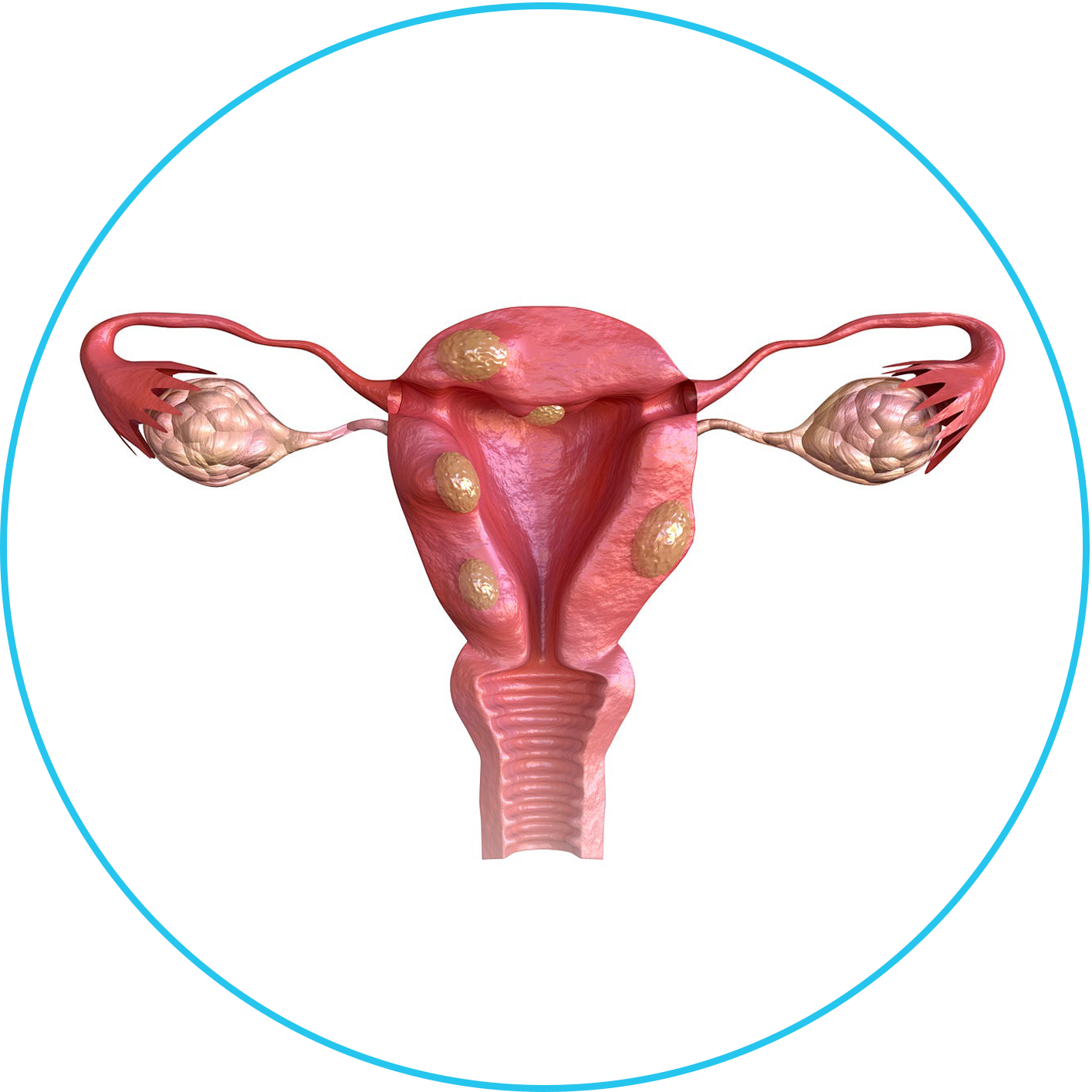 الأورام الليفية