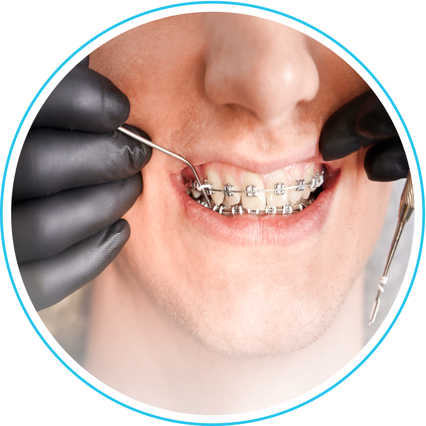 تقويم الأسنان