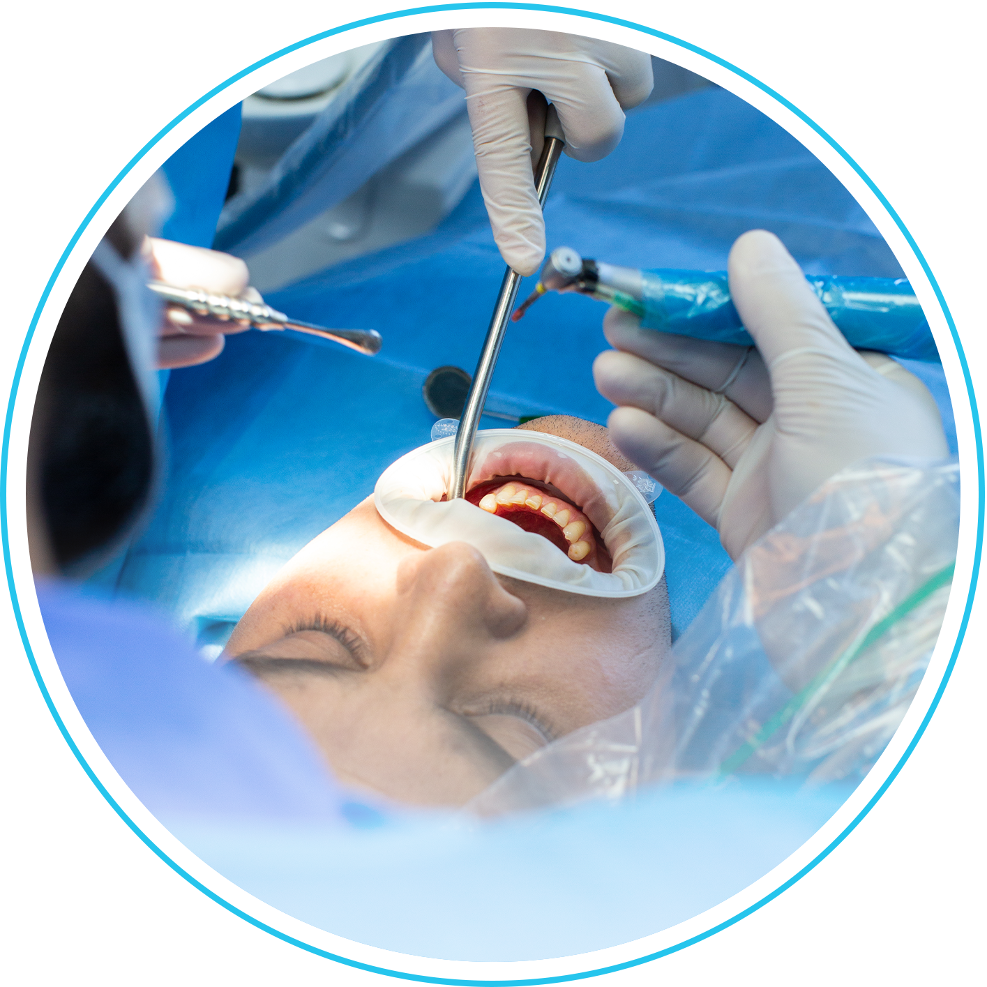 حشو الأسنان