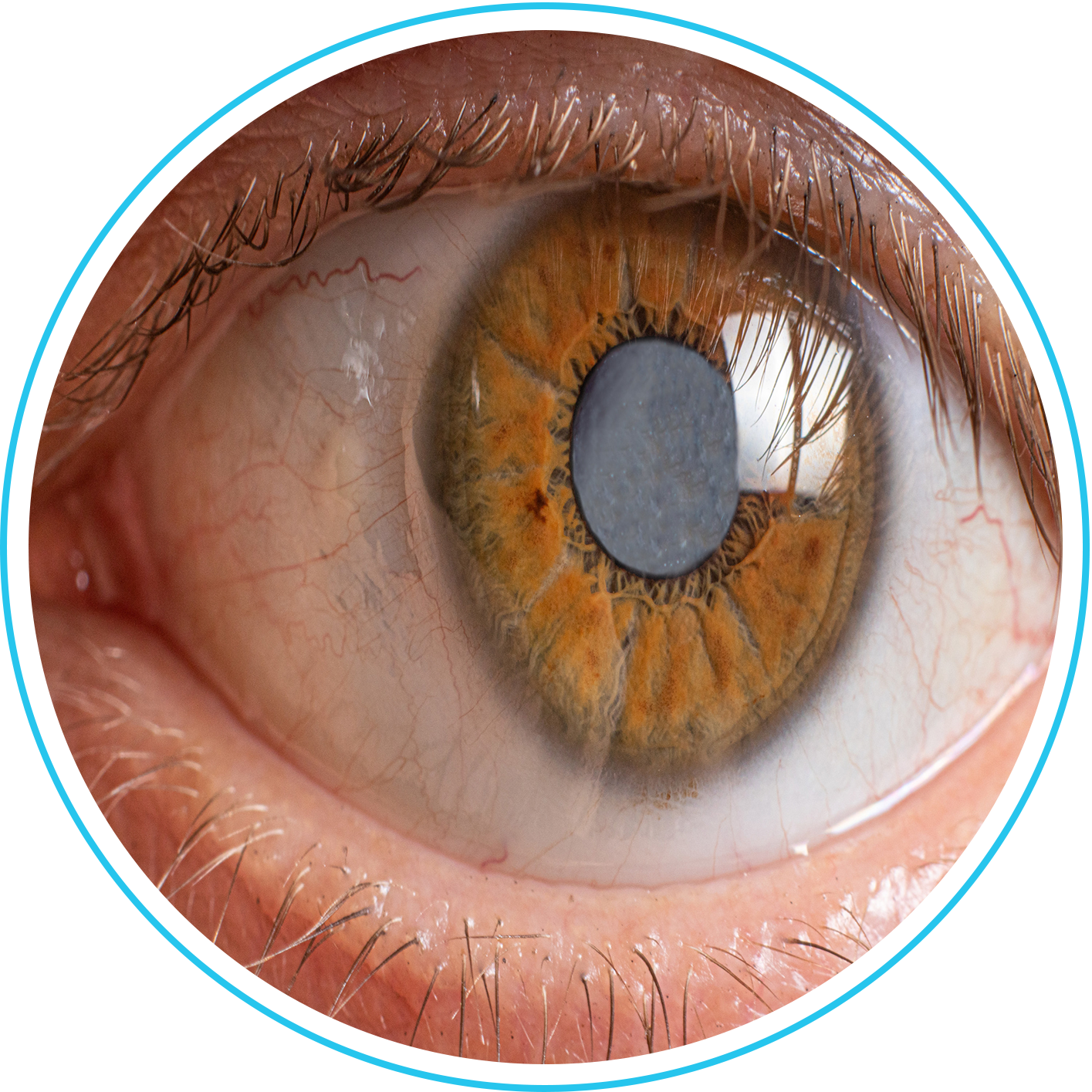 المياه البيضاء