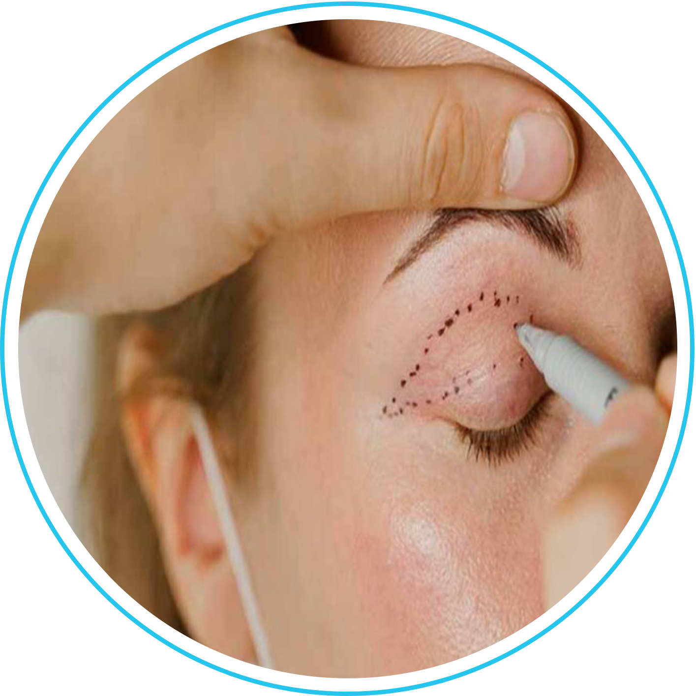 تجميل الجفون