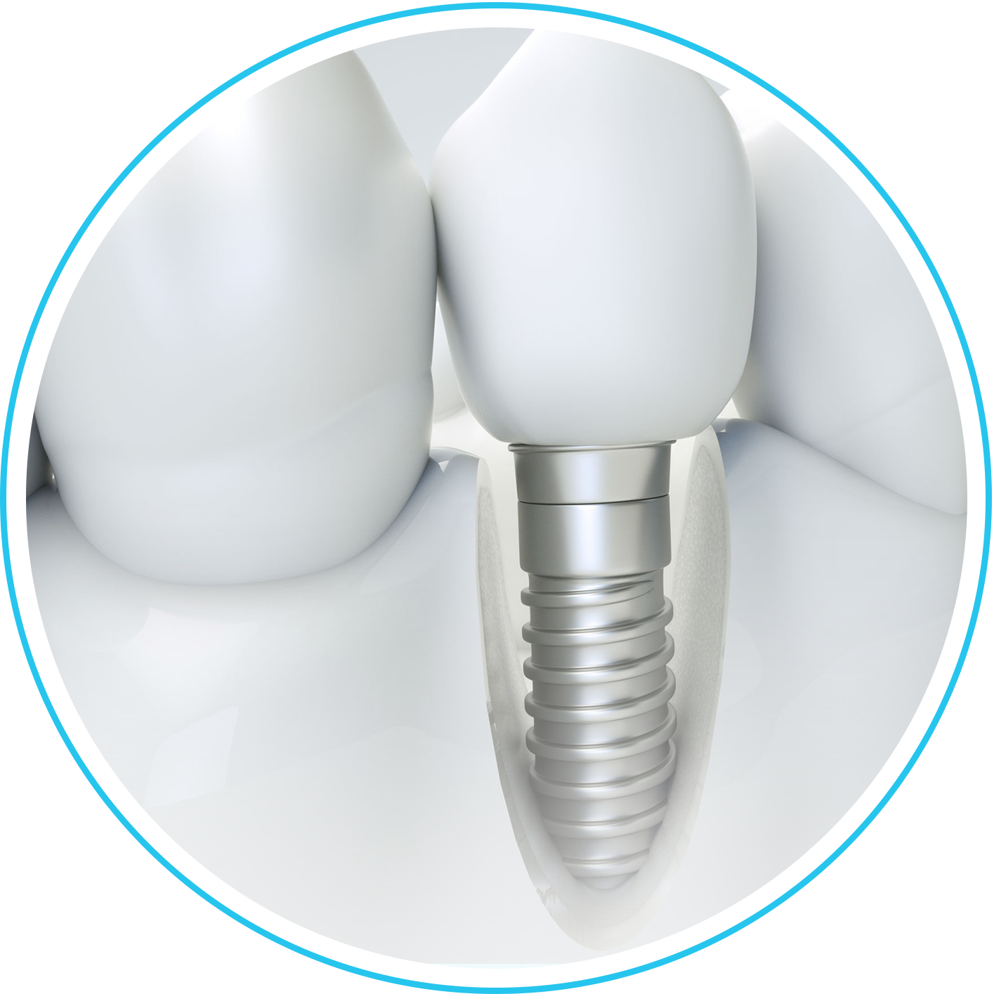 تركيبات الأسنان الثابتة