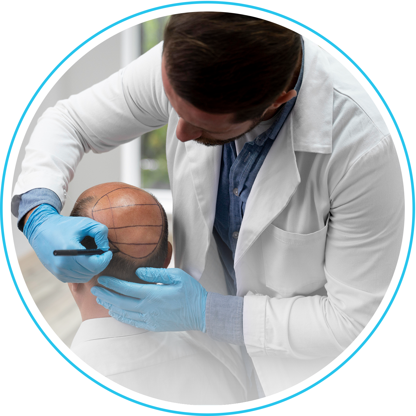 زراعة الشعر