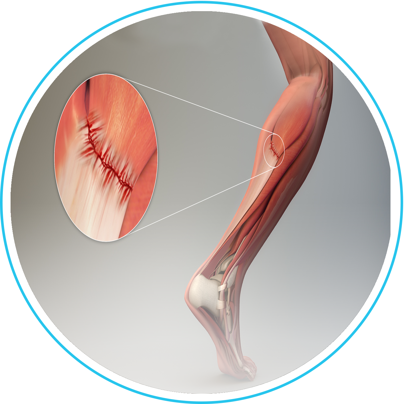 إصلاح قطع الوتر