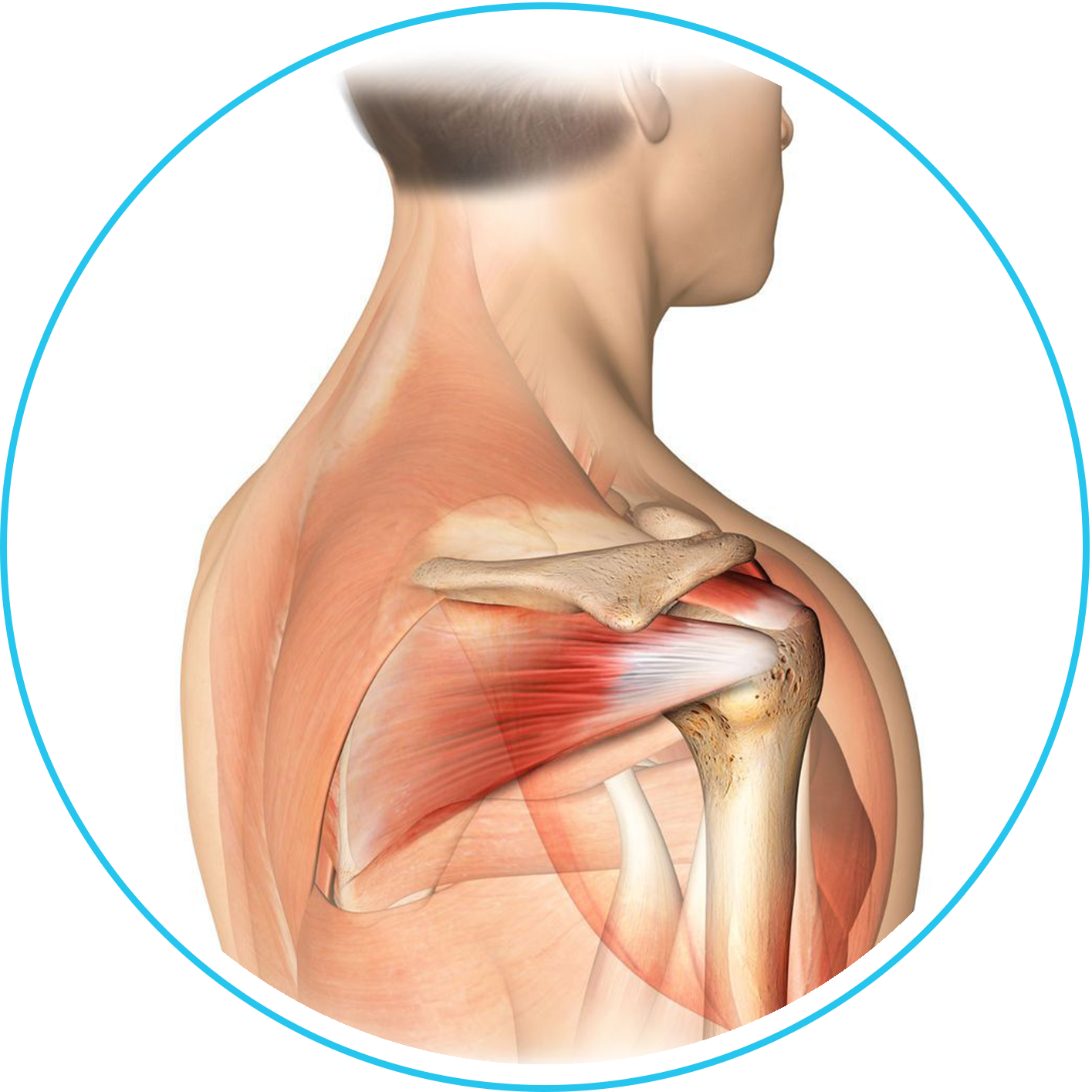 خلع الكتف المتكرر