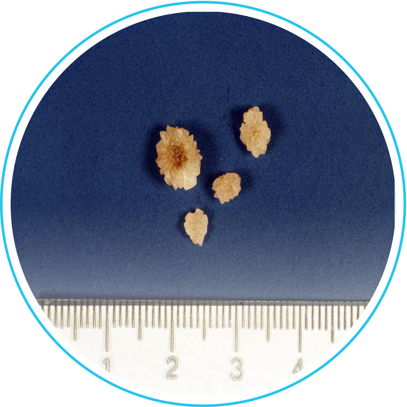 حصوات الجهاز البولي