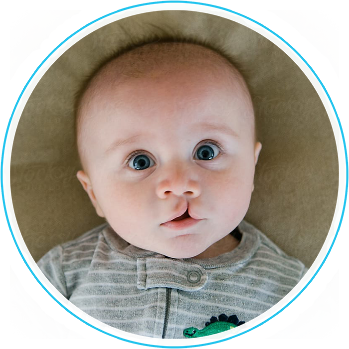 الشفاه الأرنبية