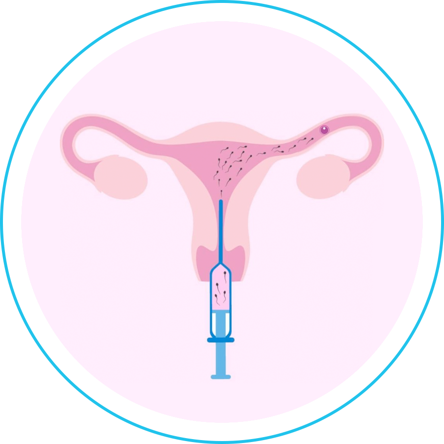 التلقيح الصناعي