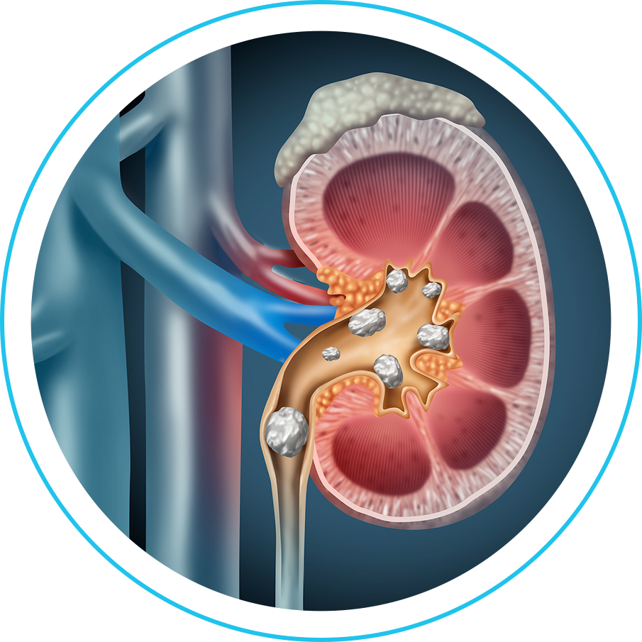 حصوات الكلى