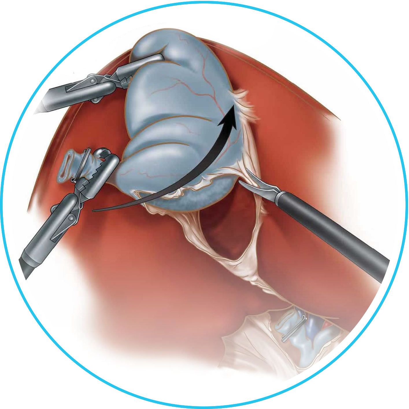 استئصال الطحال