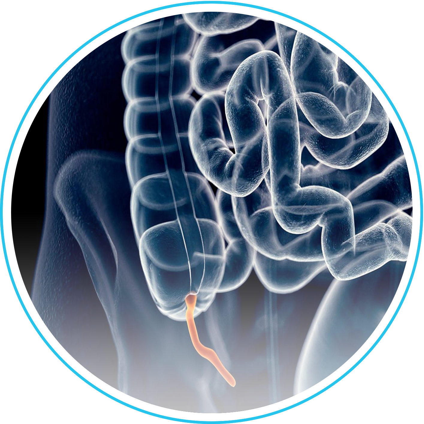 الزائدة الدودية